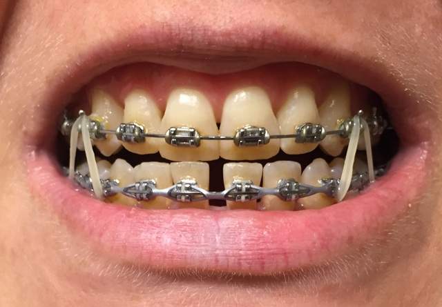 0903-braces.jpg