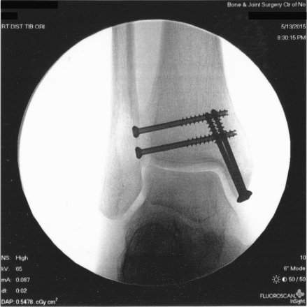 AnkleScrews2.jpg