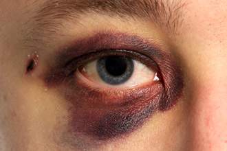 black-eye-330x220.jpg