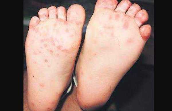 Blisters.jpg