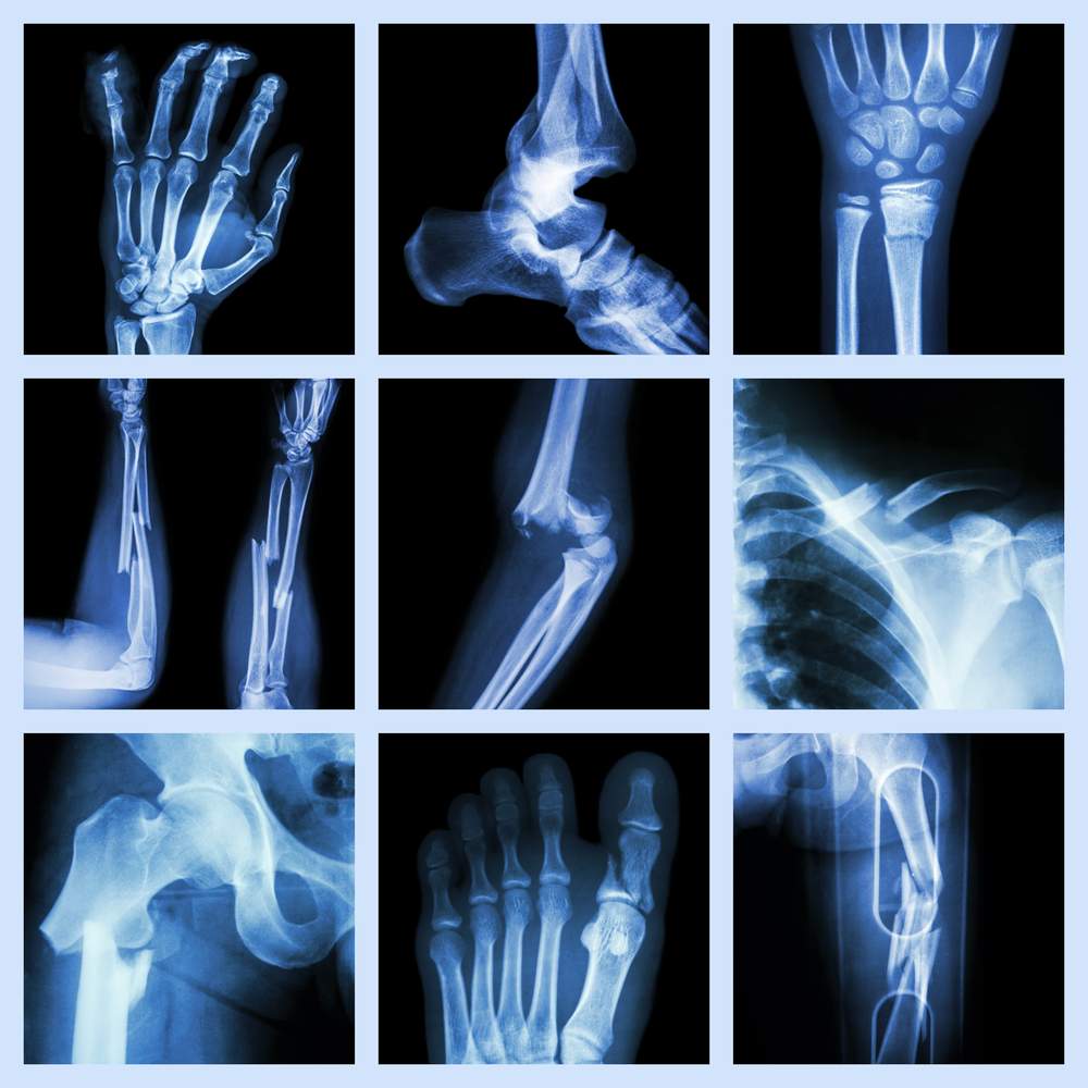 Fractures.jpg