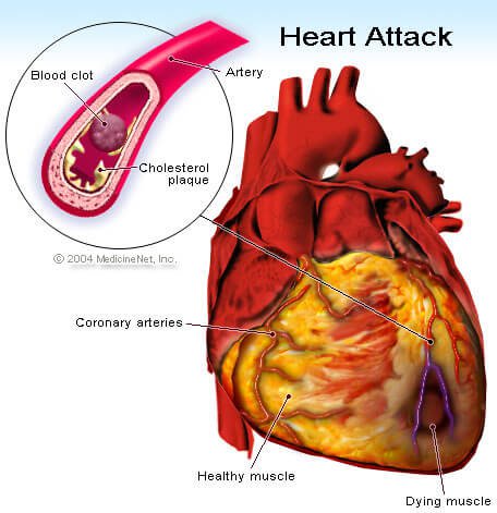 heart_attack.jpg