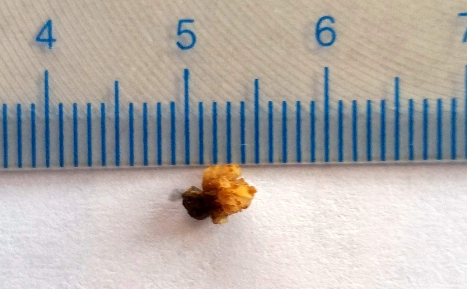 Kidney Stone  12_31_2017.jpg