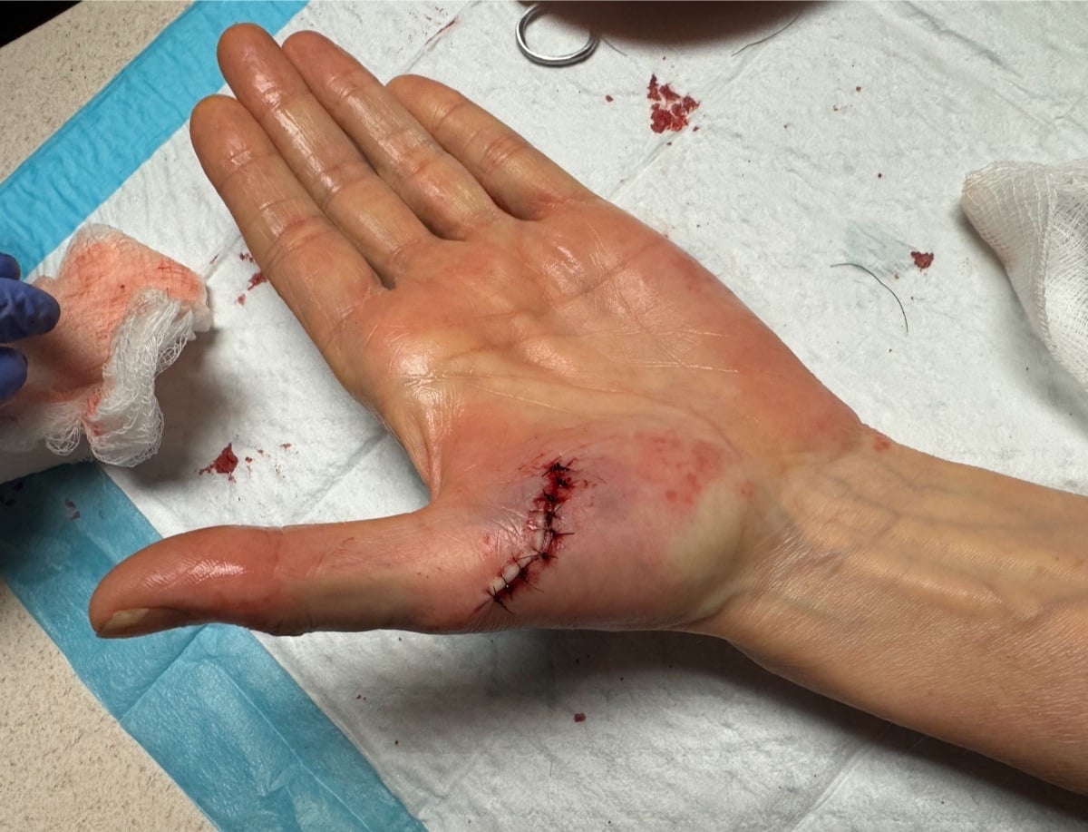 left hand damage.jpg