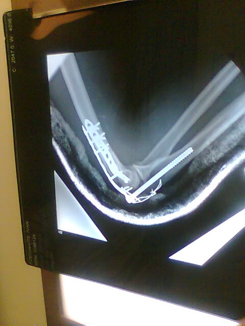 postopx-ray2.jpg