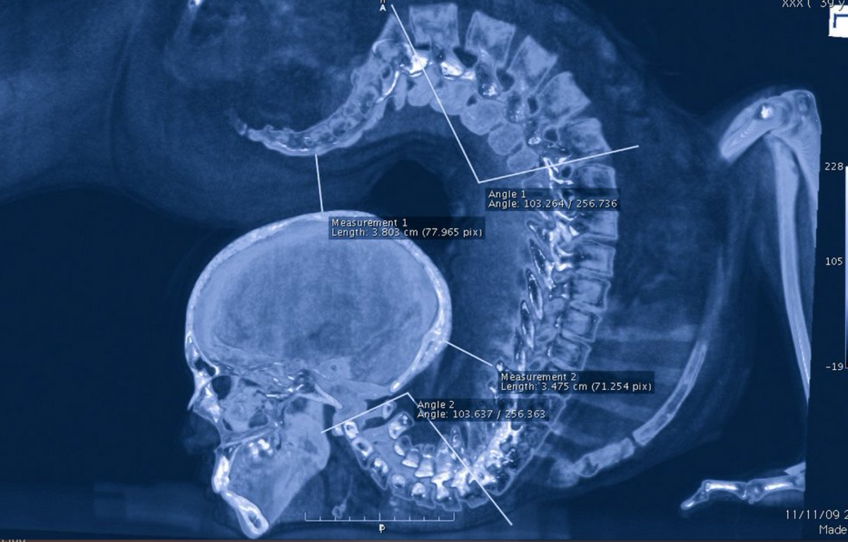 Spine%20contortionist%20xray.png