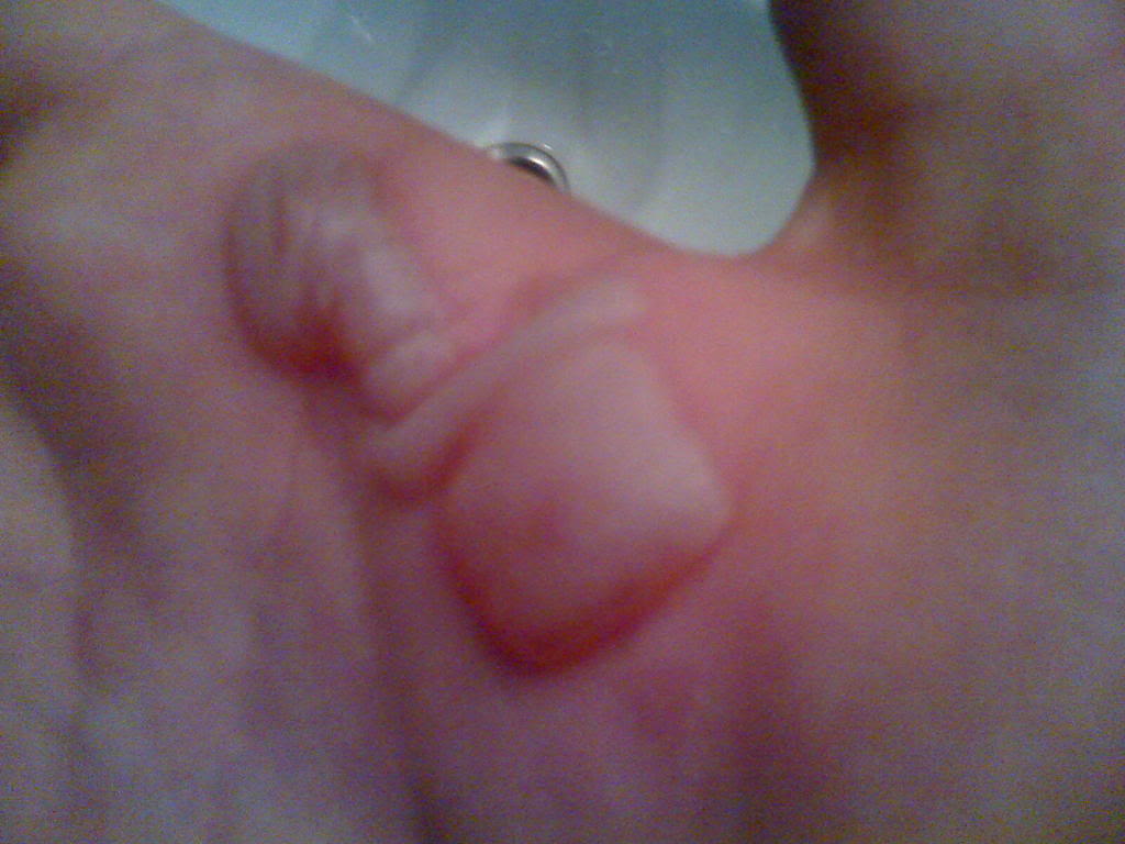 SwollenB.jpg