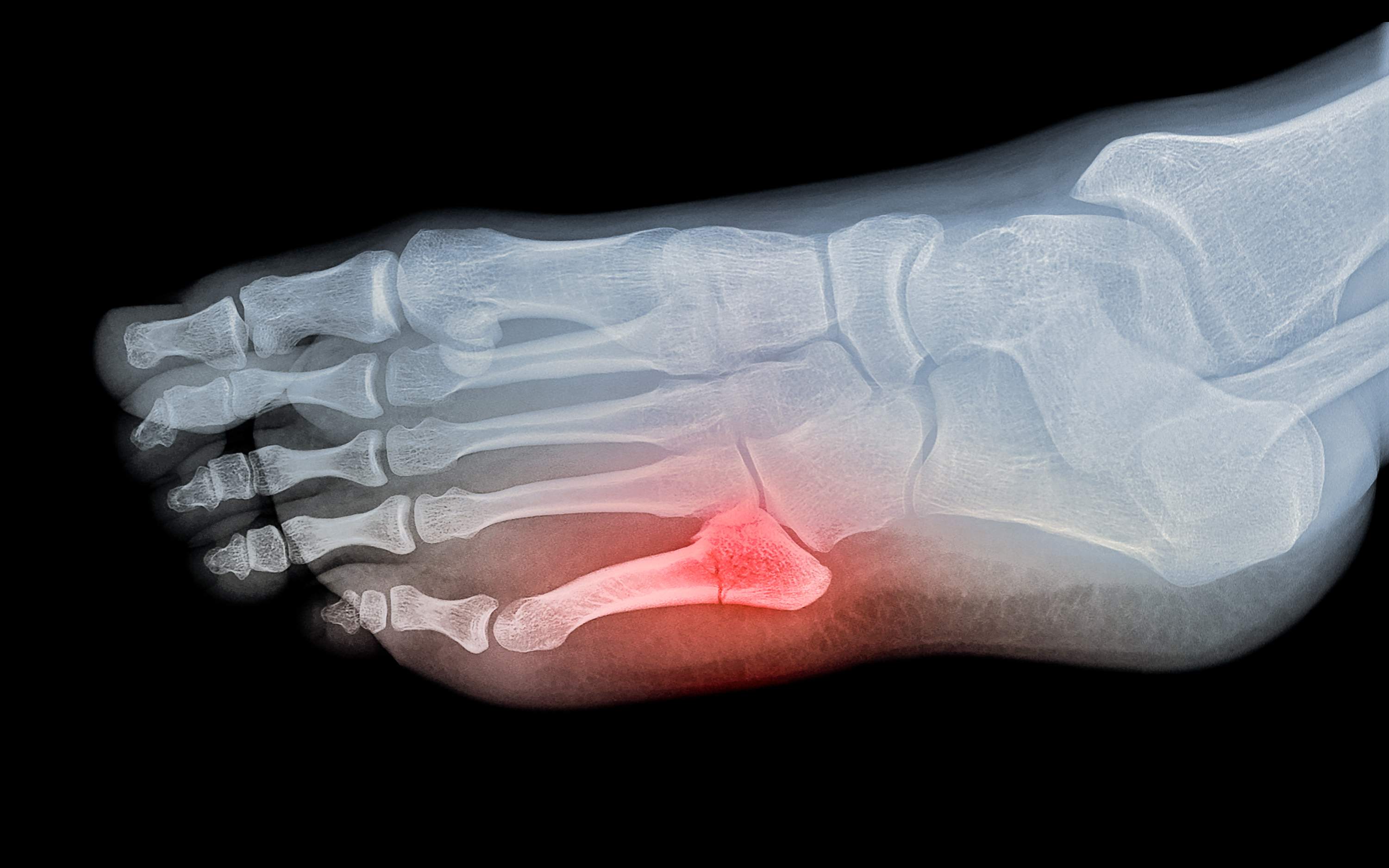 toe-fractures.jpg