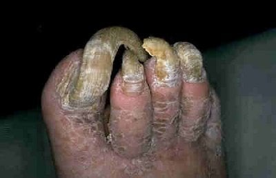 ?u=https%3A%2F%2Fi2.wp.com%2Fdamuugly.wordpress.com%2Ffiles%2F2011%2F11%2F1ugly-feet.jpg