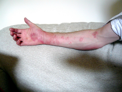 Urticaria.jpg