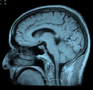 VK Brain Scan (anim).gif
