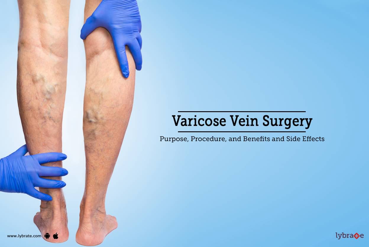 varicose-veins-surgery.jpg