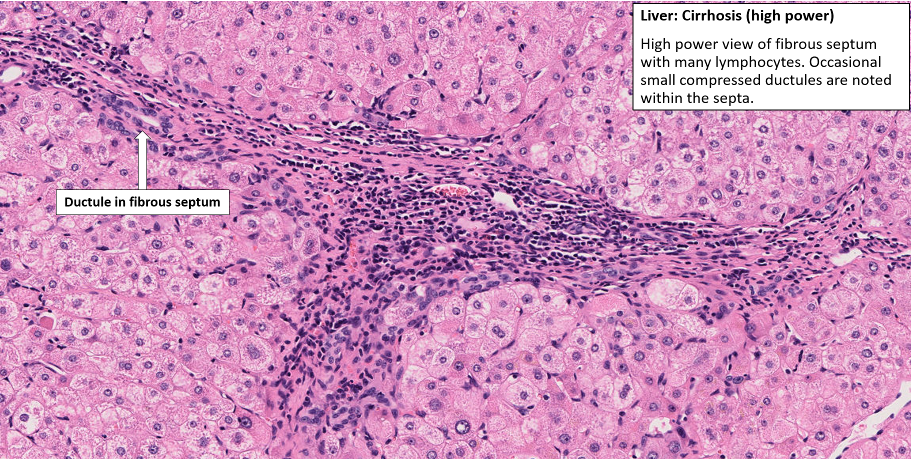 1395-3890-5534-Liver-Cirrhosis-4.png